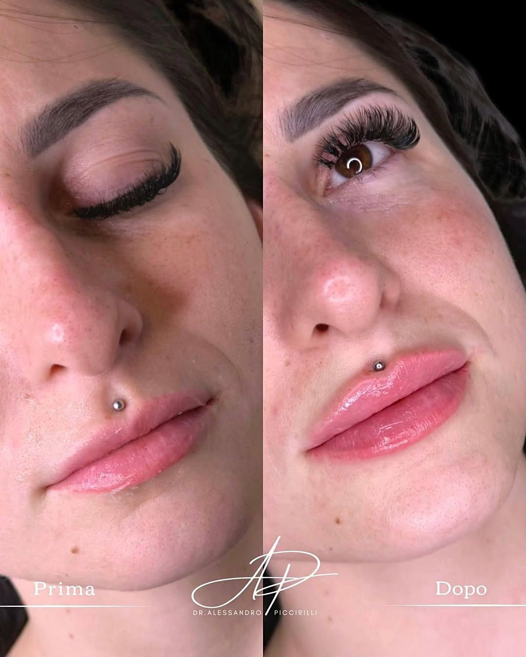 Armonia e volume naturale per labbra definite