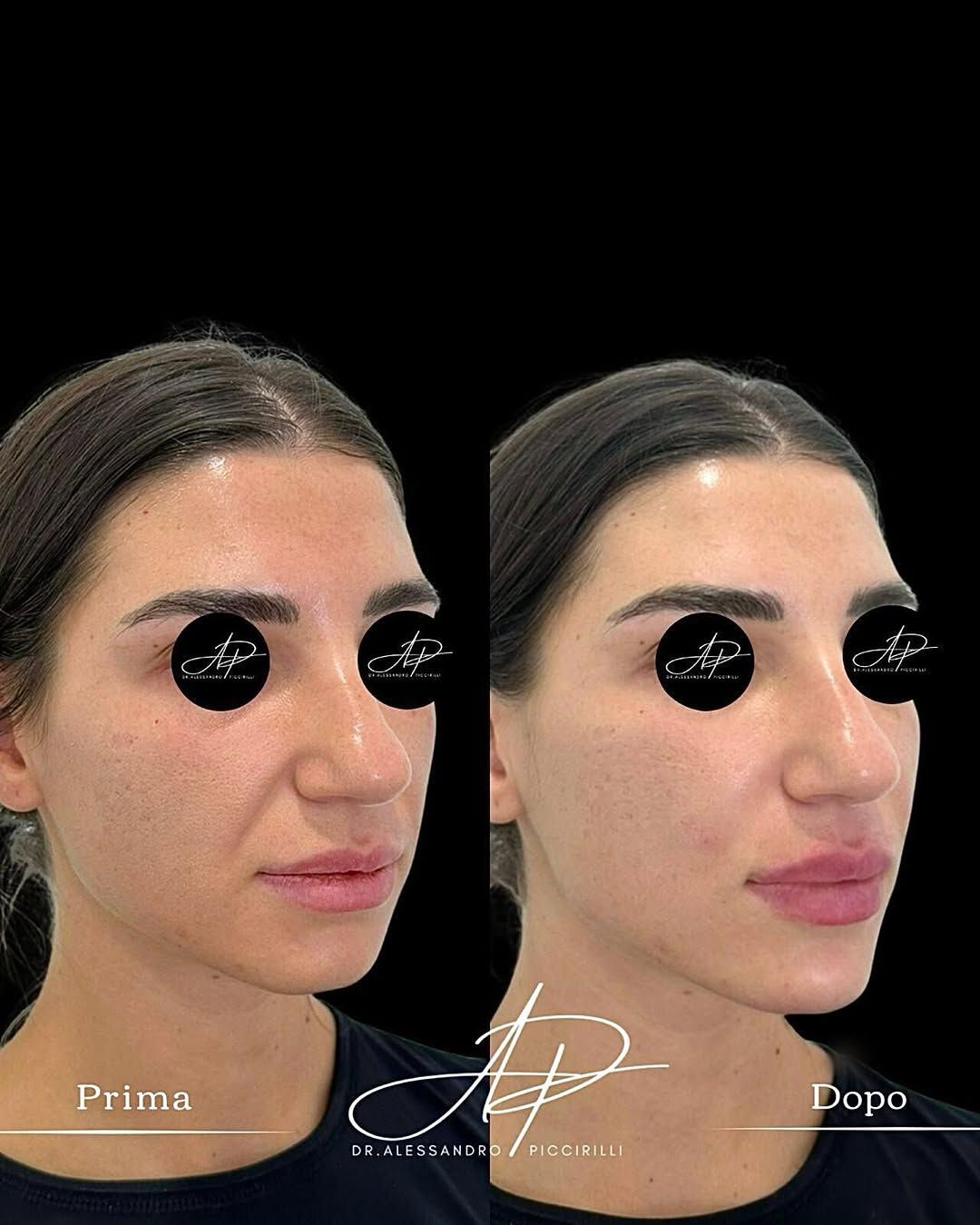Armonia e naturalezza nel profilo nasale