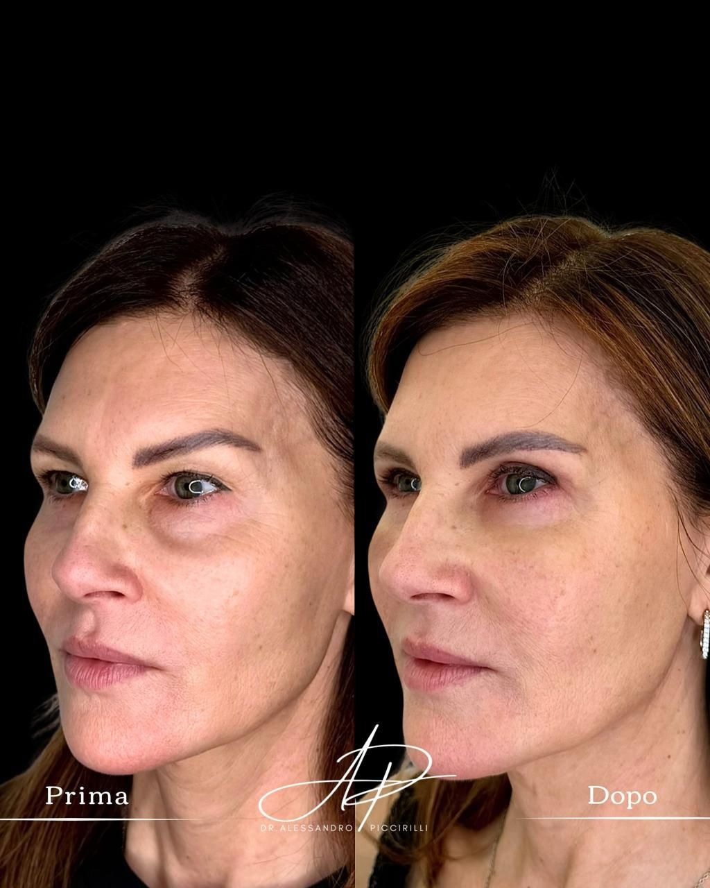 Sguardo rigenerato e armonia del volto naturale