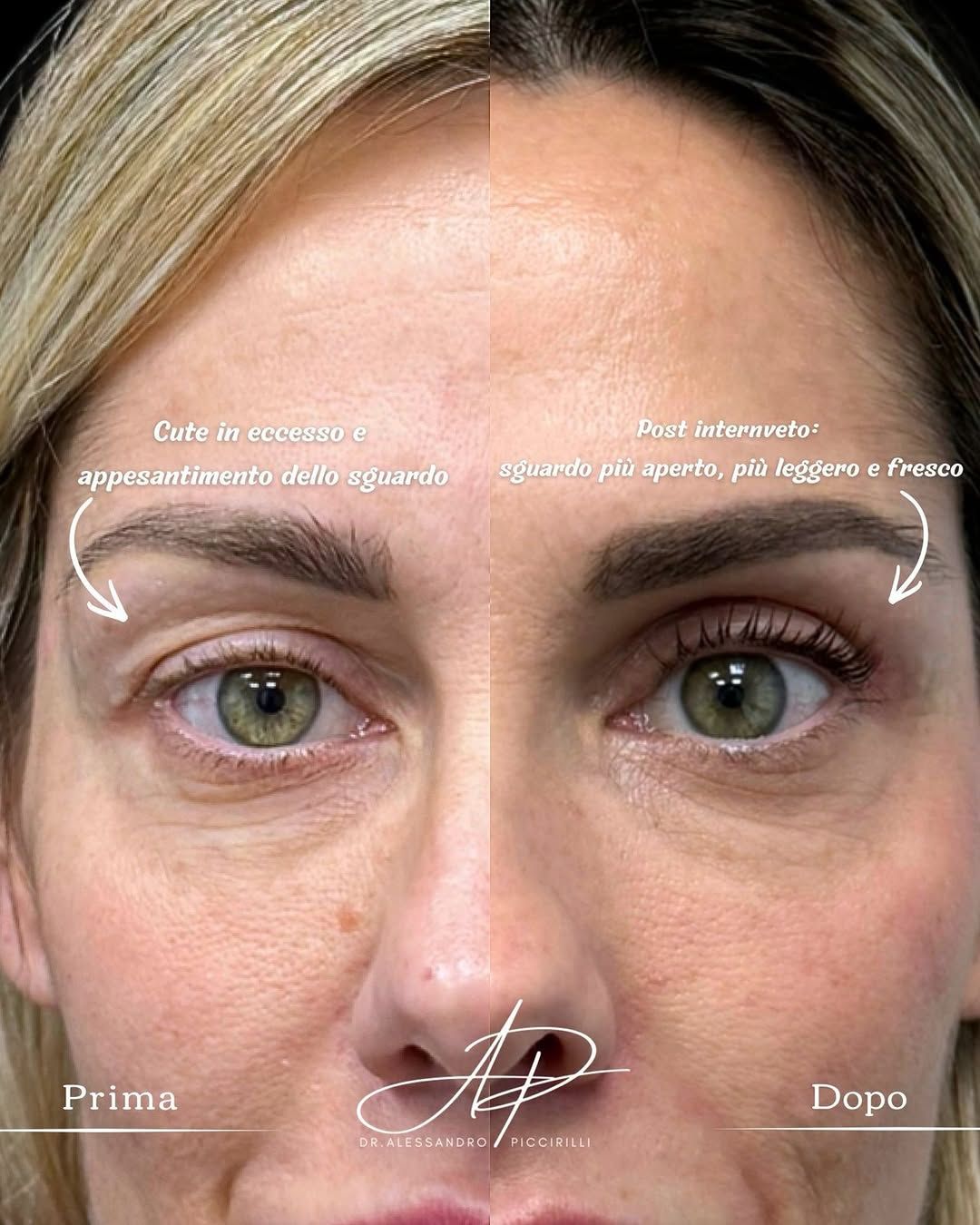 Sguardo rigenerato e naturalezza post-blefaroplastica