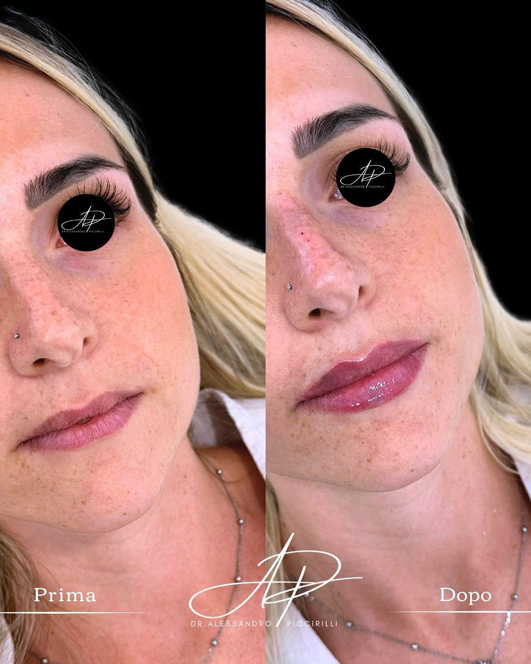 Armonia e volume naturale per il tuo sorriso