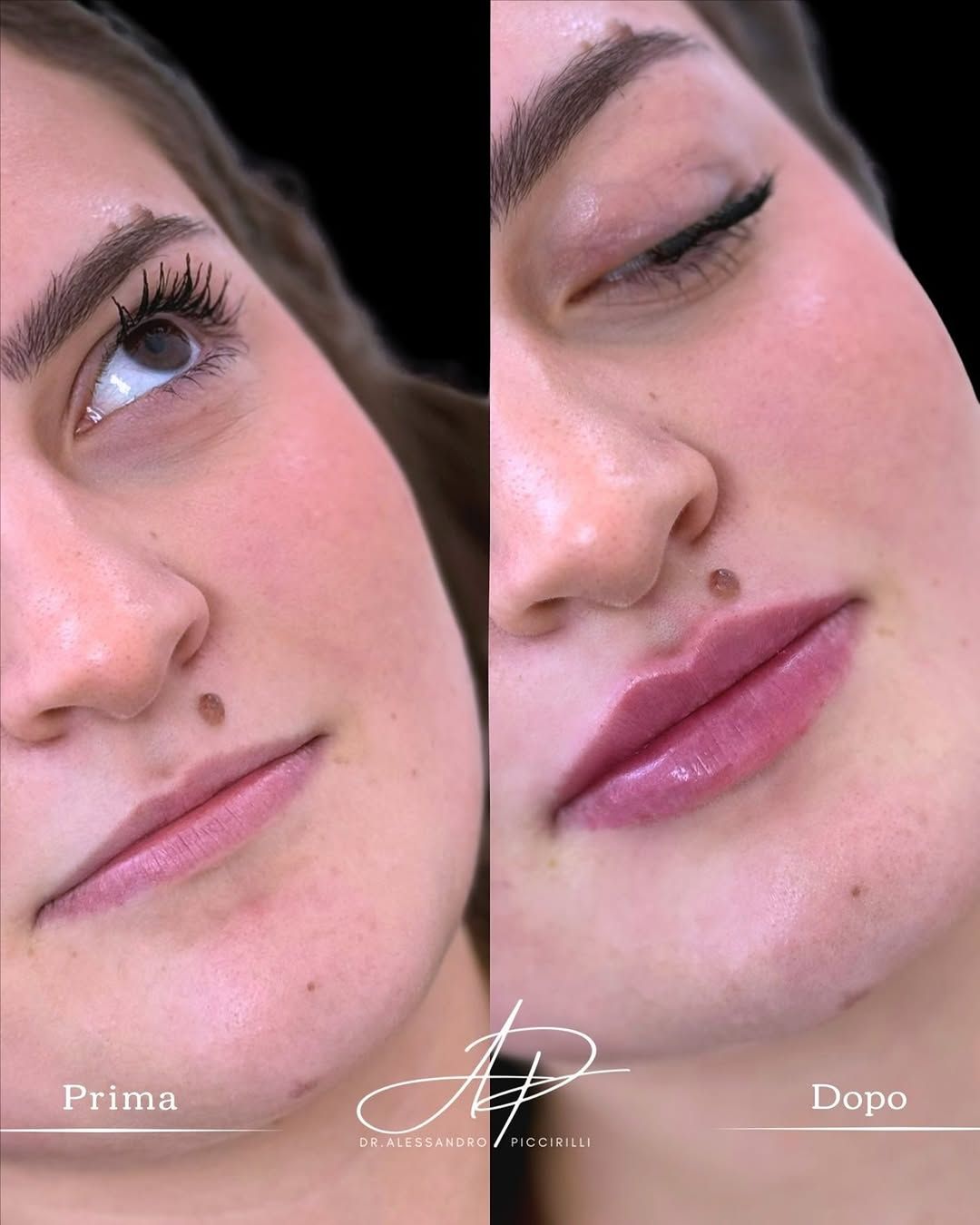 Armonia e volume naturale per le labbra