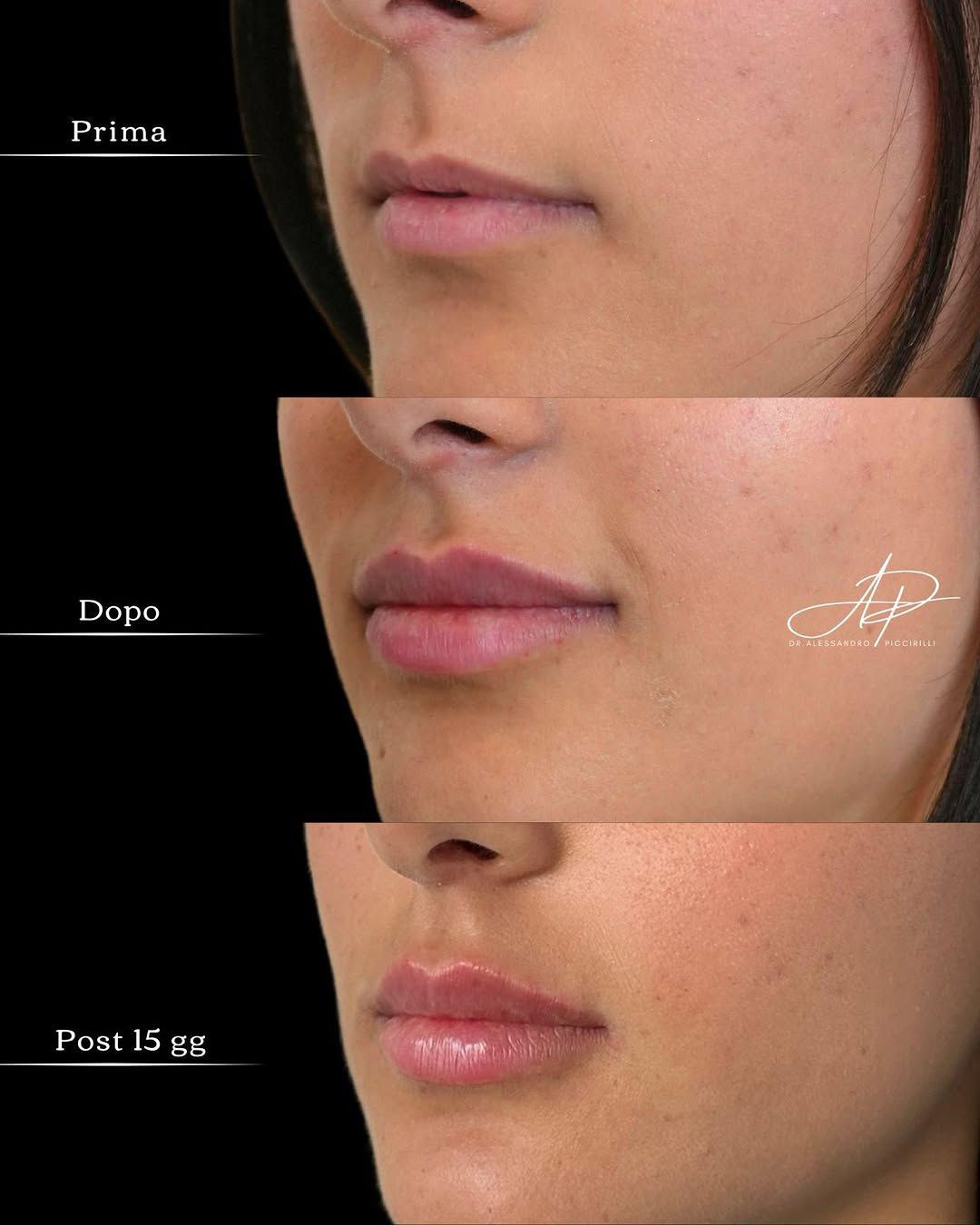 Armonia e volume naturale per labbra definite