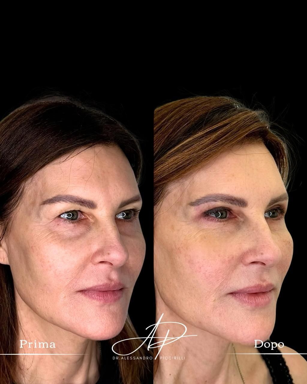 Sguardo rigenerato e volumi ridefiniti con naturalezza