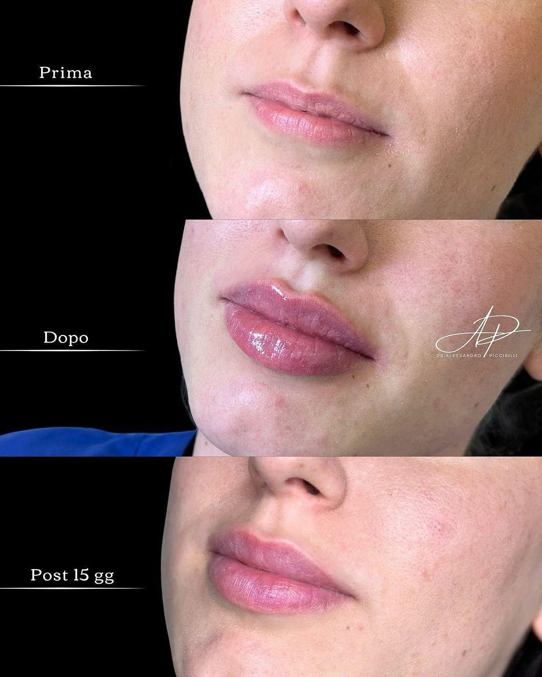 Armonia e volume naturale: evoluzione post-trattamento labbra