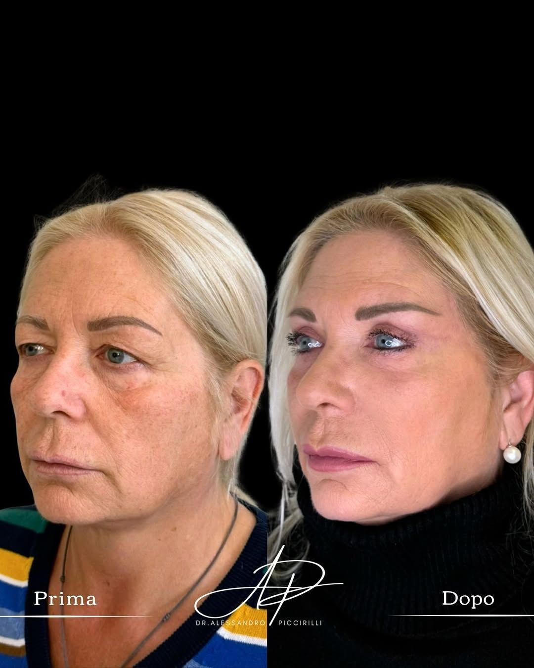 Sguardo rigenerato con tecnica di blefaroplastica avanzata