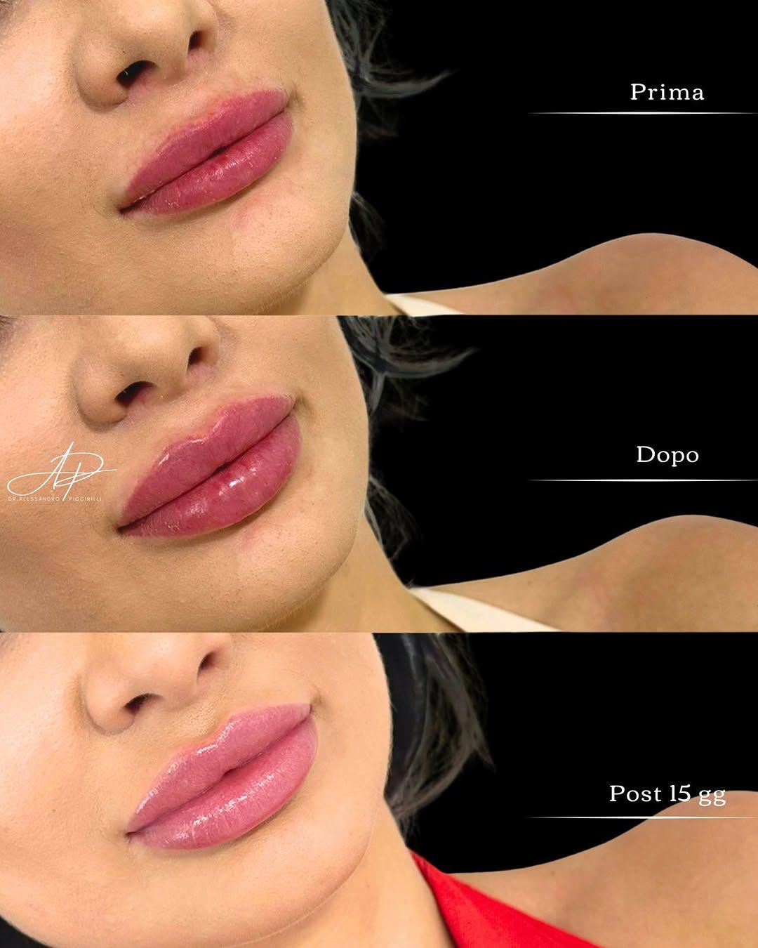 Armonia e volume naturale per labbra definite