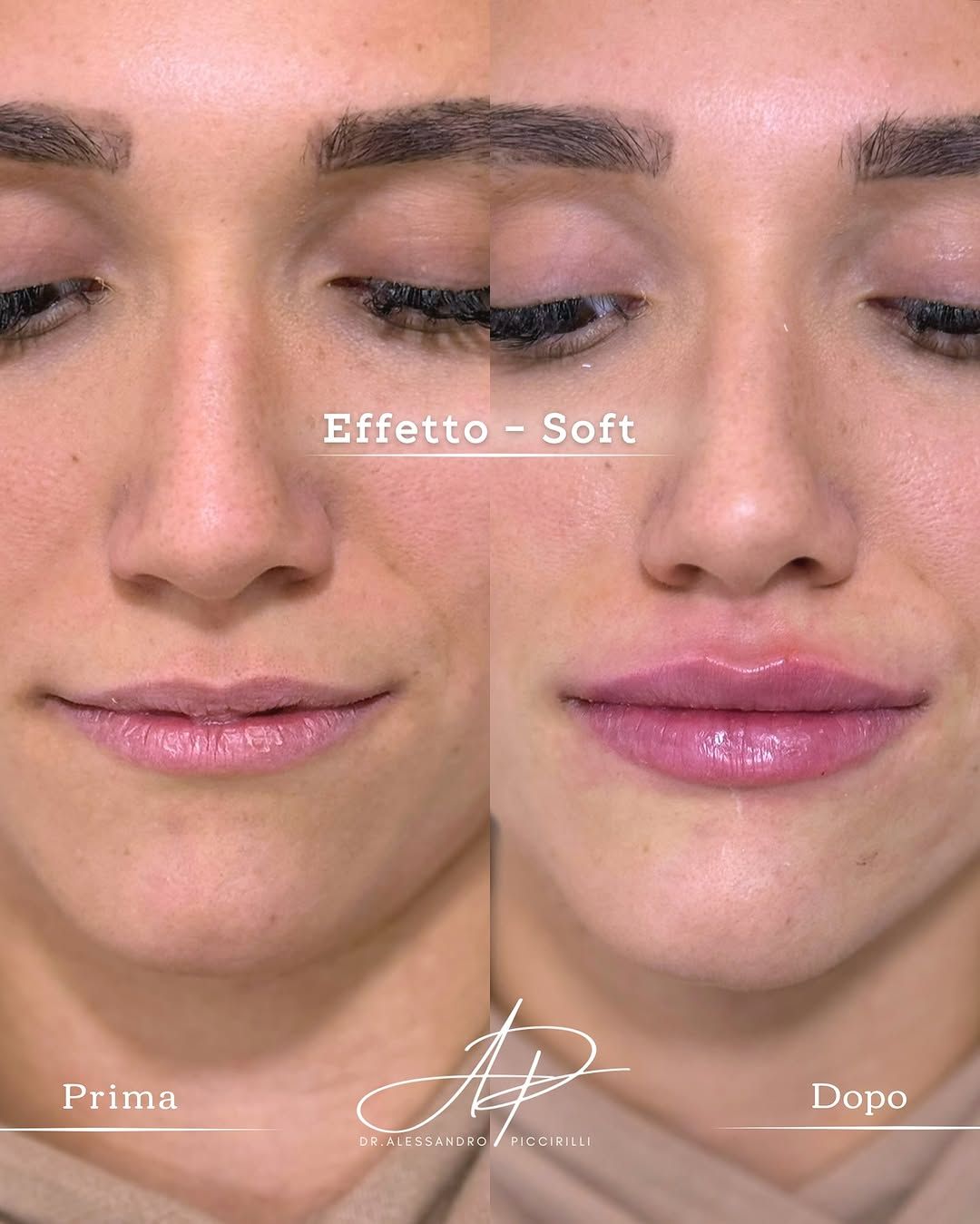 Armonia e volume naturale per labbra definite