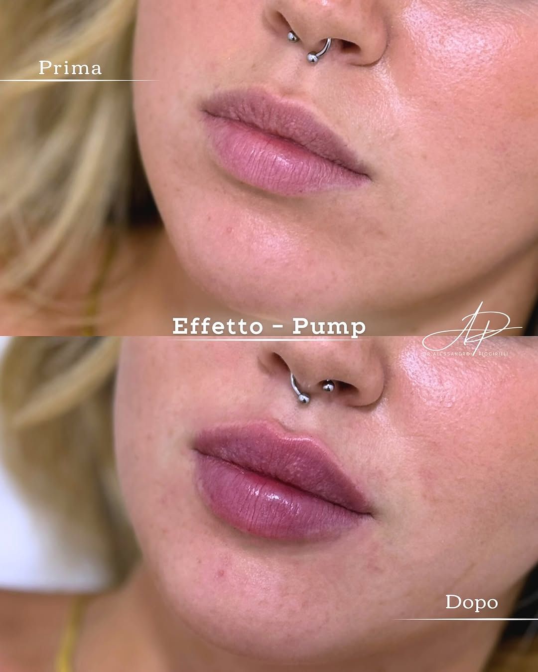 Armonia e volume naturale per labbra definite