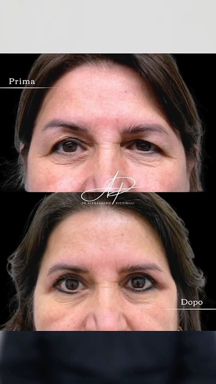 Sguardo rigenerato con naturalezza e precisione chirurgica