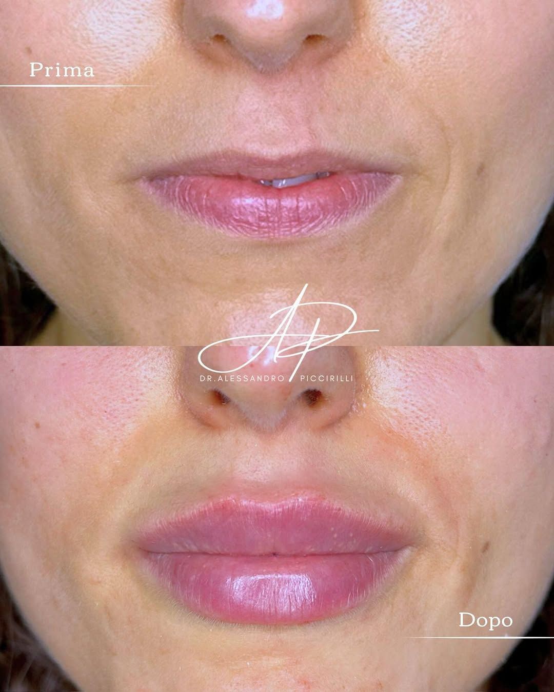 Filler Labbra e Soft Restoration