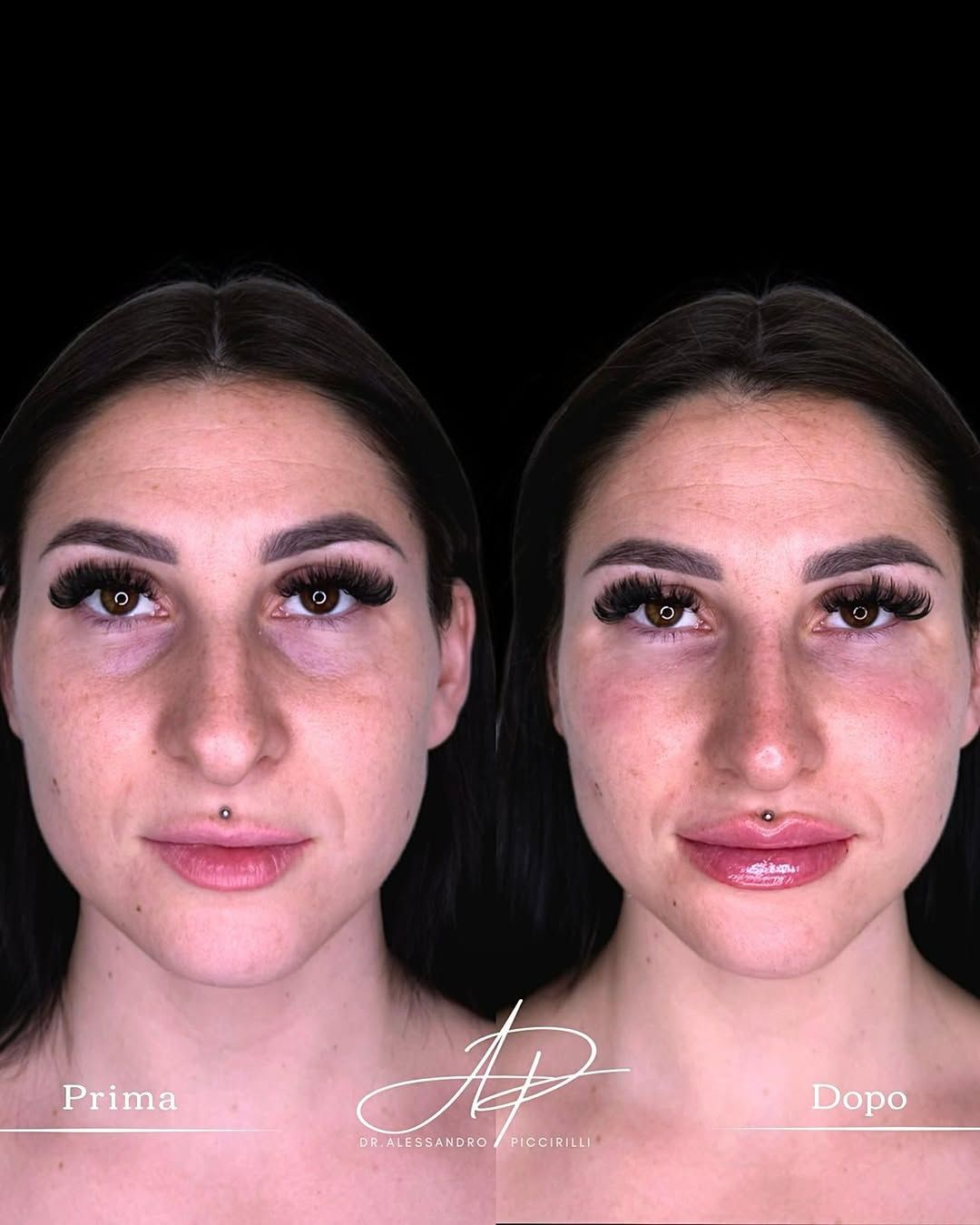 Armonia e volume per un sorriso naturale