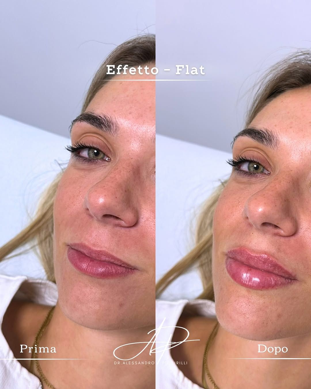 Armonia e volume naturale per le tue labbra