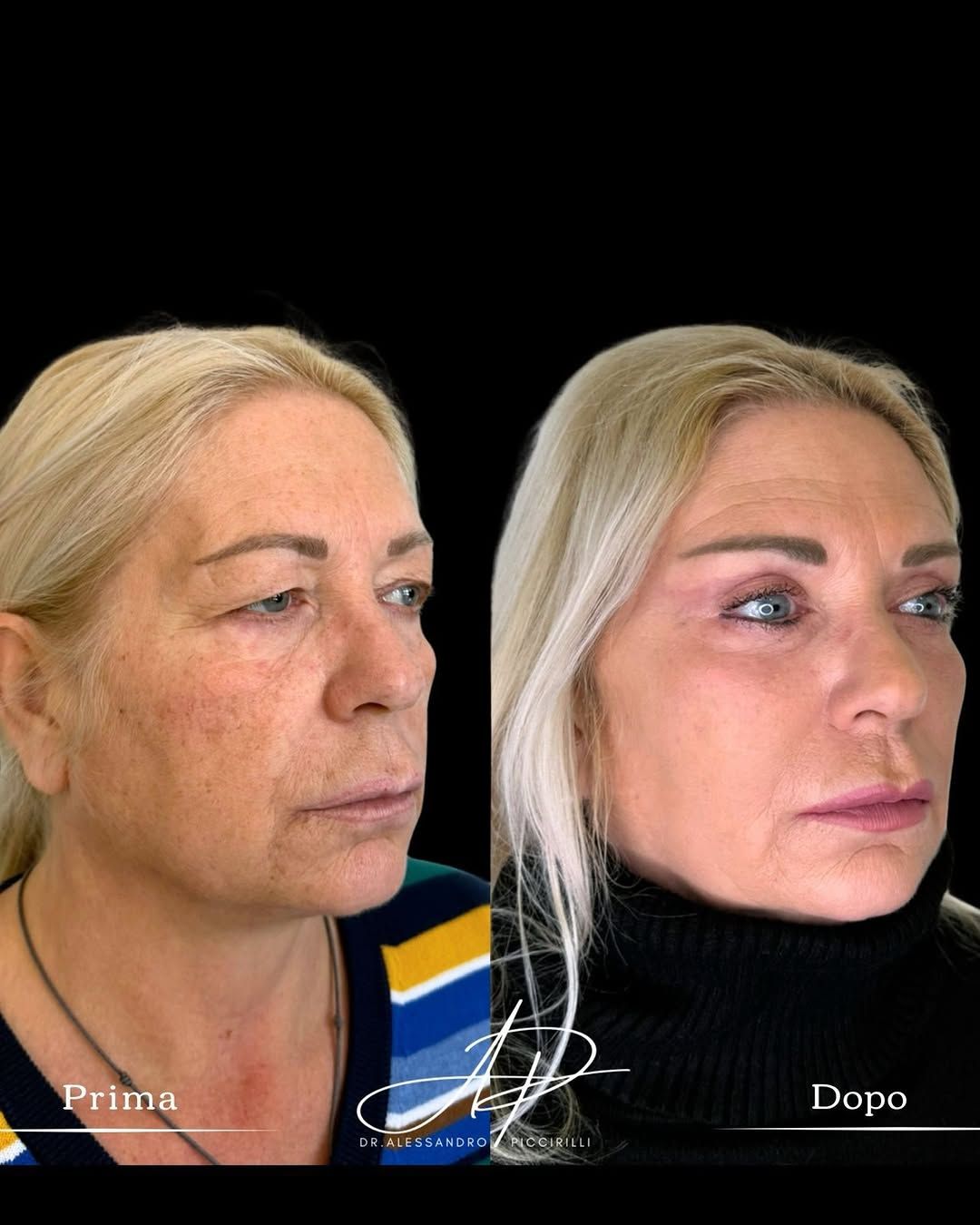 Sguardo rigenerato attraverso la chirurgia palpebrale avanzata
