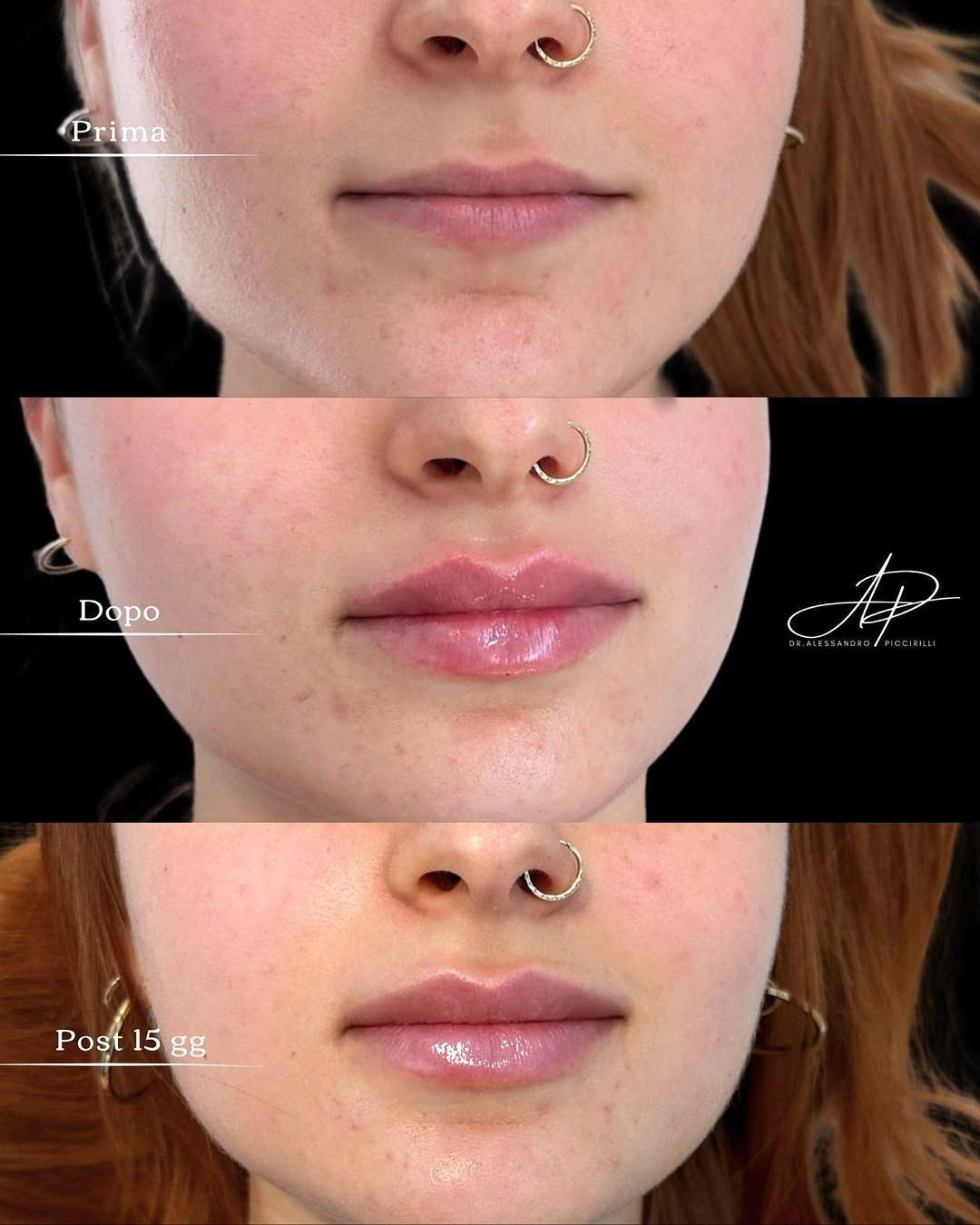 Armonia e volume naturale per le tue labbra