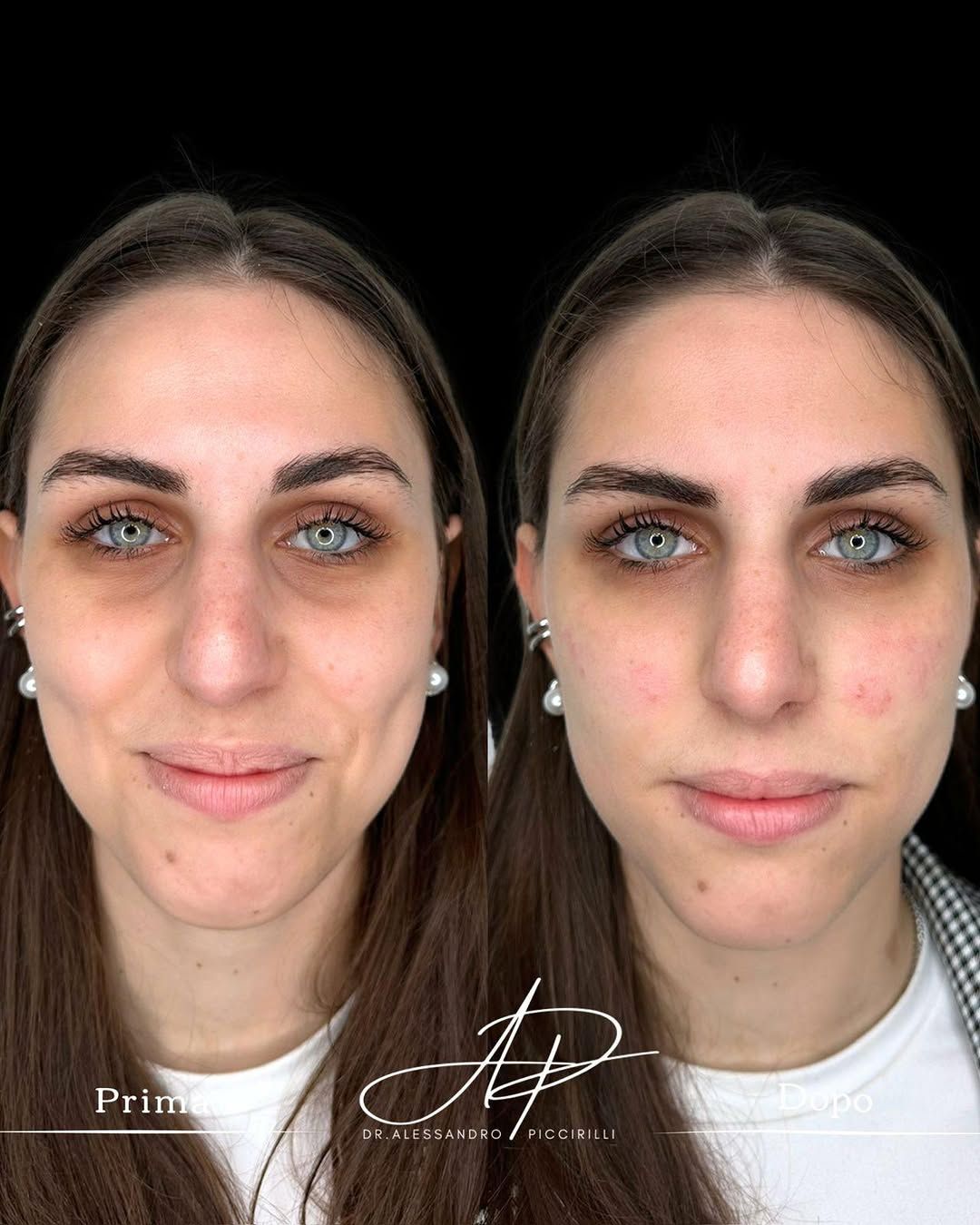 Sguardo rigenerato con correzione mirata delle occhiaie