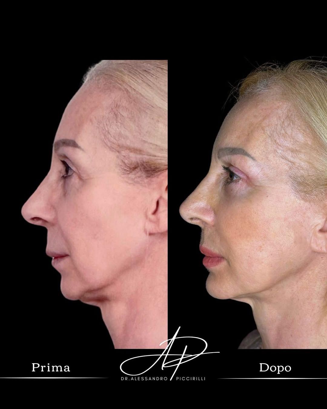 Lifting viso e collo