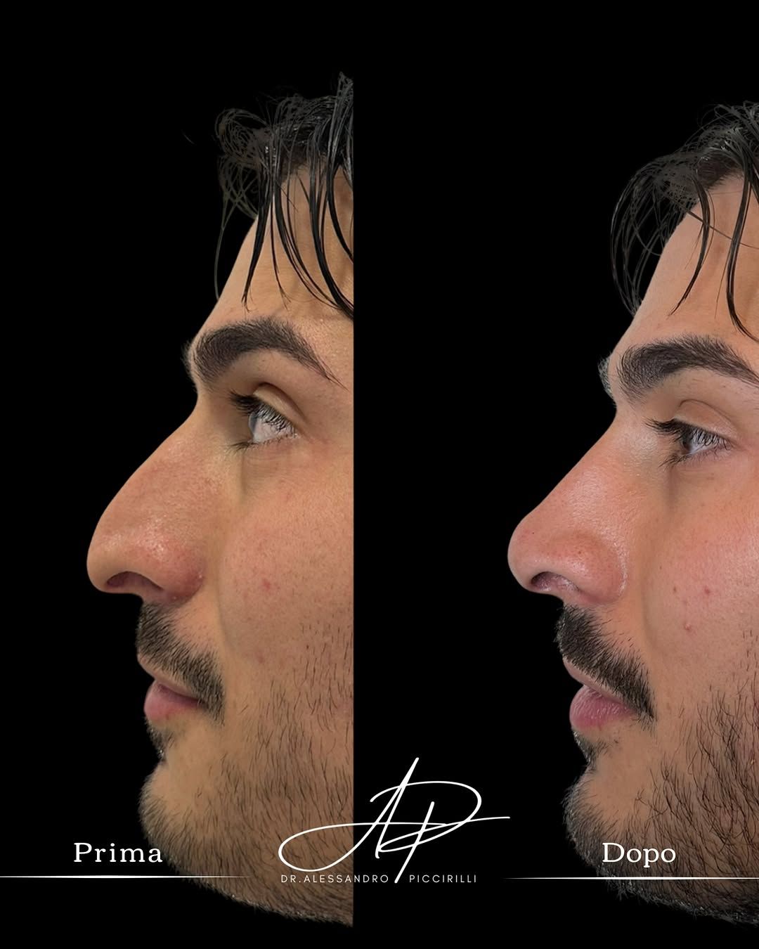 Rinoplastica e rinosettoplastica